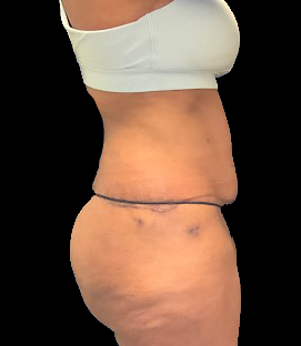 After - Lateral