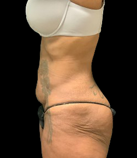 Before - Lateral