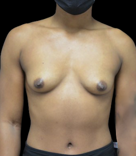 Before - DR49