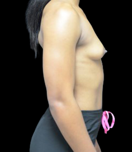 Before - Right Lateral