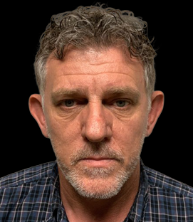 Before - DR51