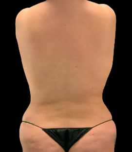 After - Back