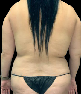 Before - Back