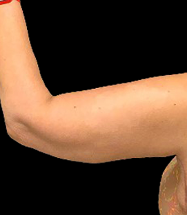 After - Left Lateral