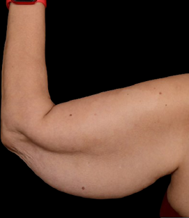 Before - Left Lateral