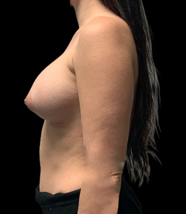 After - Right Lateral