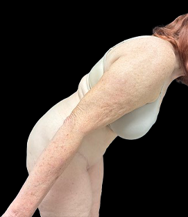 After - Right Lateral