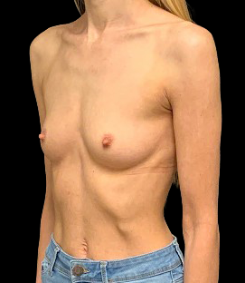 Before - Left Oblique